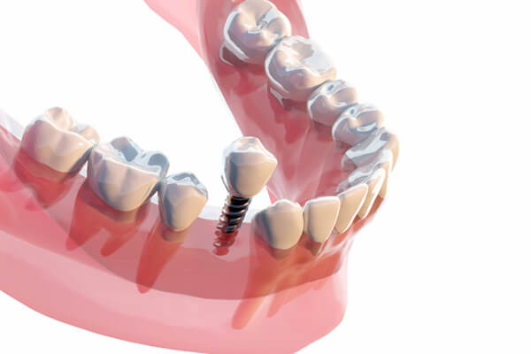 歯科治療の画像での説明をイメージした画像